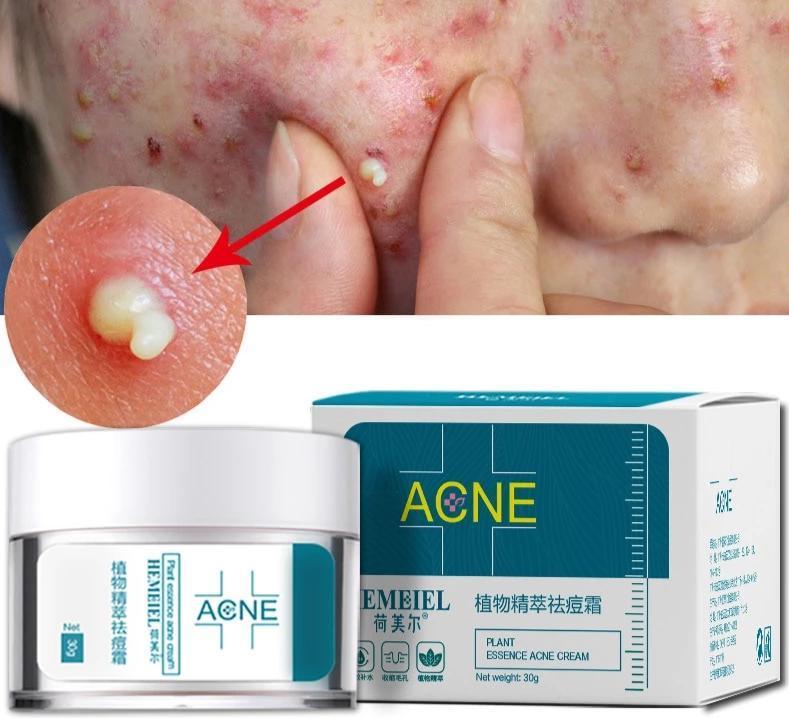 Acne Treatment Cream